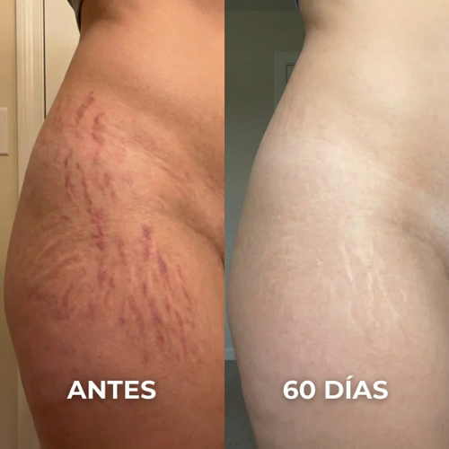 Stick Reparador de Cicatrices con Silicona Médica – Suaviza y Reduce Marcas Visibles
